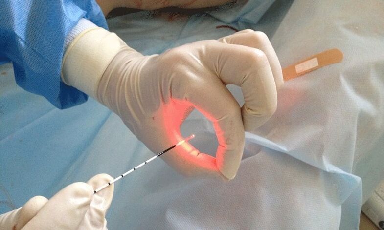 Trattamento laser per la prostatite